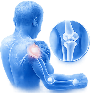 Arthritis